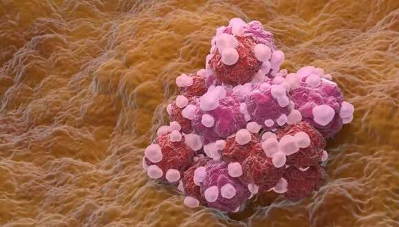 Researchers present RNA-based nanodrug treatment for ovarian cancer