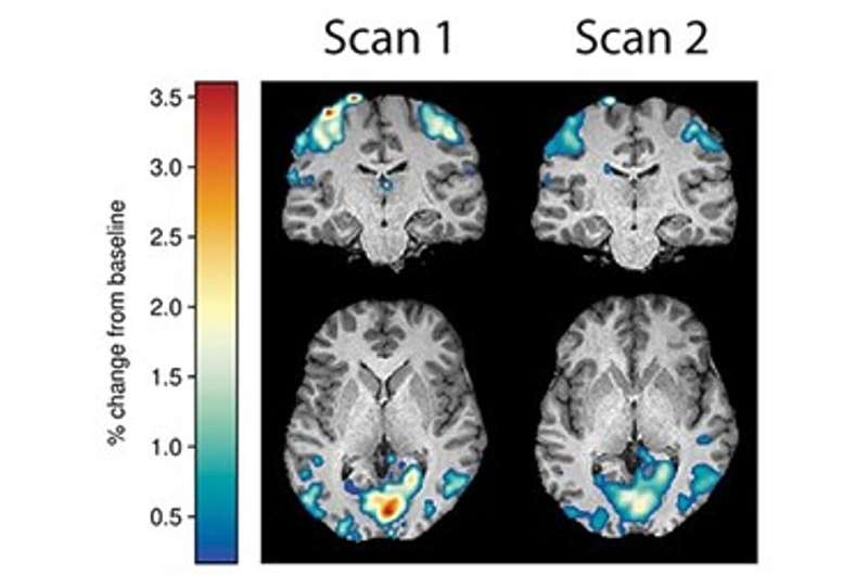 Researchers publish a new model to predict improvement in brain health