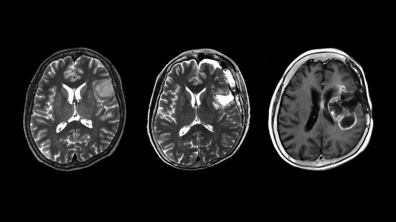 Researchers report that the outcome of patients with a rare type of astrocytoma, a neuron tumor, is worse than expected