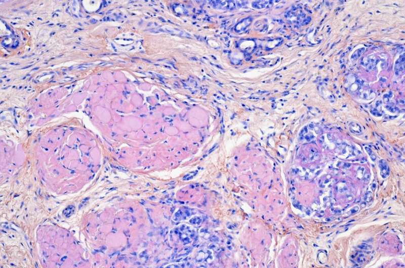 Researchers discover a new amyloidosis