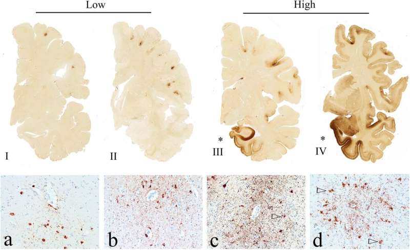 Review strengthens evidence that repetitive head impacts can cause CTE