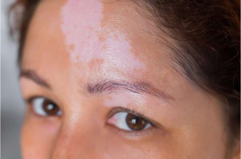 Risk for vitiligo increased for transplant recipients