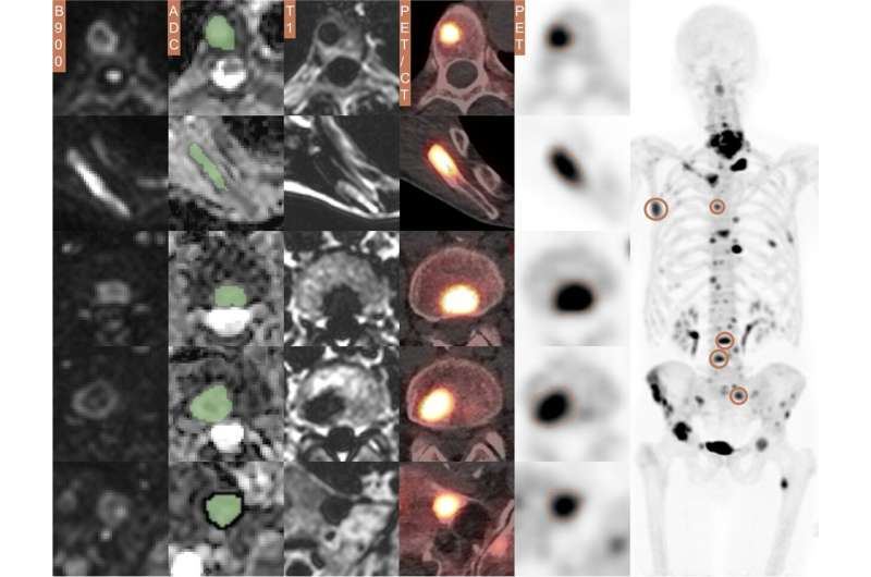 Scientists now able to predict response to radium-223 treatment in prostate cancer bone metastases