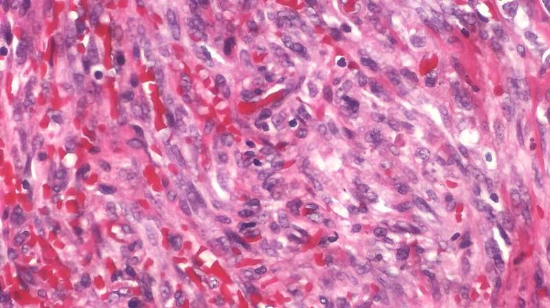 Scientists uncover the 'Rosetta stone' of sarcoma research to personalise treatment