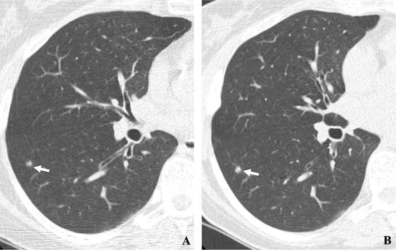 Screening sharply improves lung cancer long-term survival
