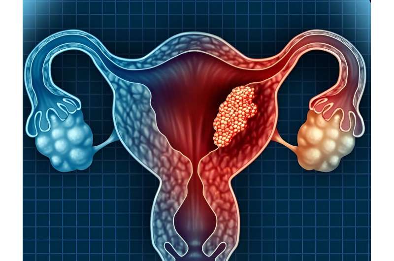 Selinexor increases PFS for endometrial cancer with TP53 mutations