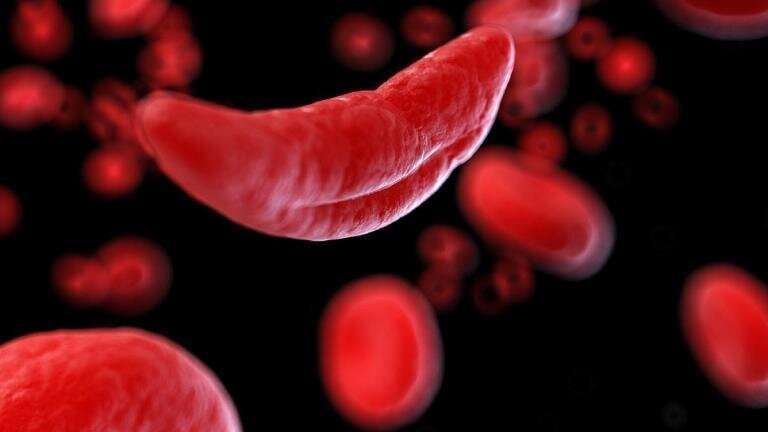 Sickle cell disease is 11 times more deadly than previously recorded