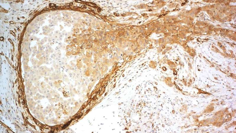 Significant discovery in breast cancer research: Inhibiting collagen XVIII function weakens cancer cells