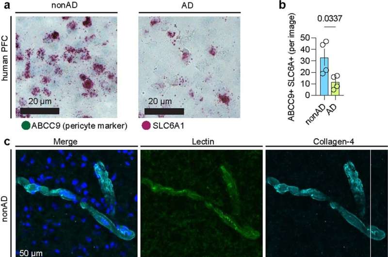 Single-cell dissection of Alzheimer's vascular changes across six brain regions