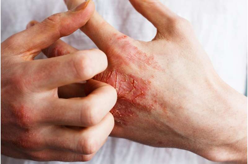 Skin diseases pose a psychosocial burden
