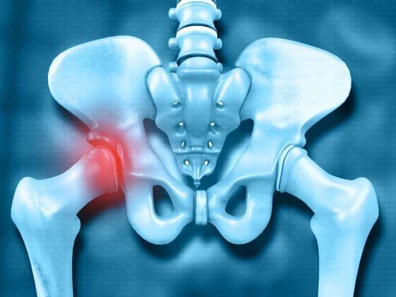 Sliding hip screws feasible for trochanteric fractures