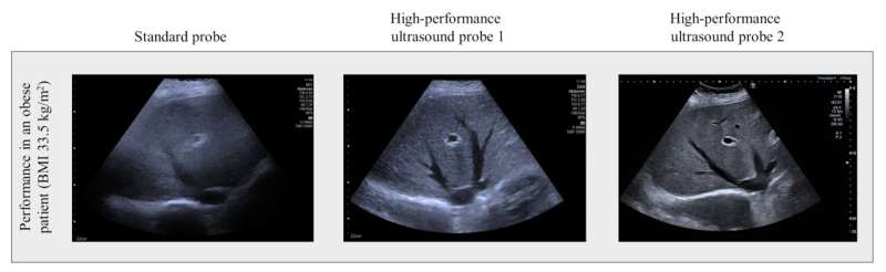 Special probes improve ultrasound imaging in obese patients