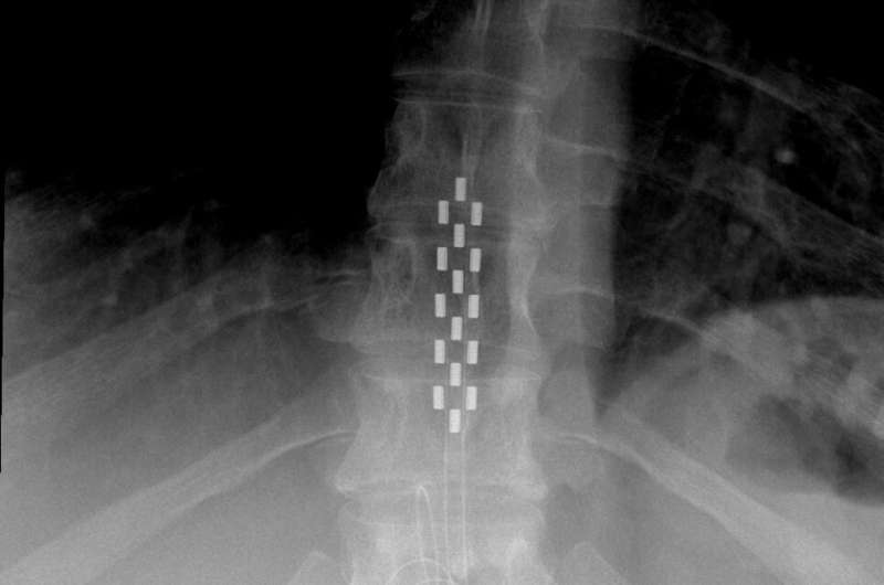 Spinal cord stimulation doesn't help with back pain, says new review