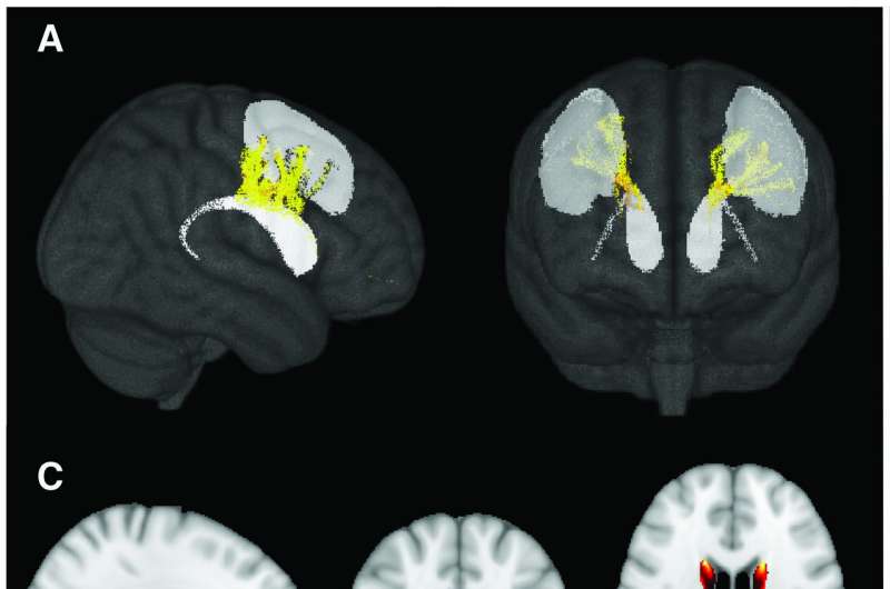 Structural changes in habit forming brain circuitry linked to eating disorders