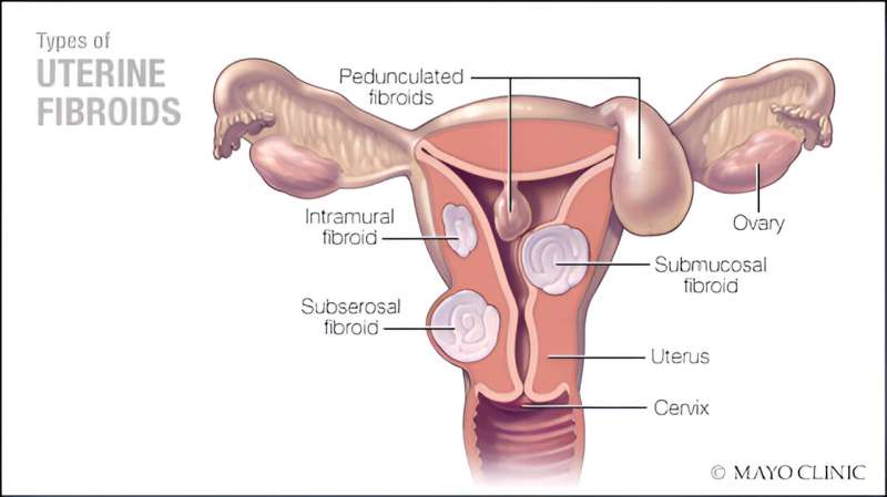 Study compares surgical treatment options for uterine fibroids