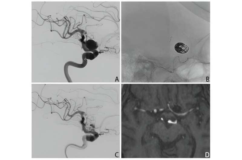 Study confirms safety of new flow-diverting stent in the treatment of brain aneurysms