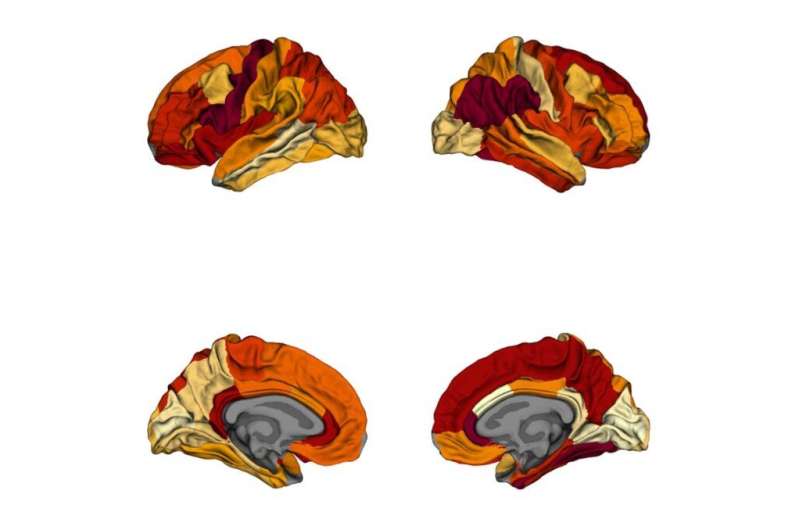 Study finds obesity-related neurodegeneration mimics Alzheimer's disease 