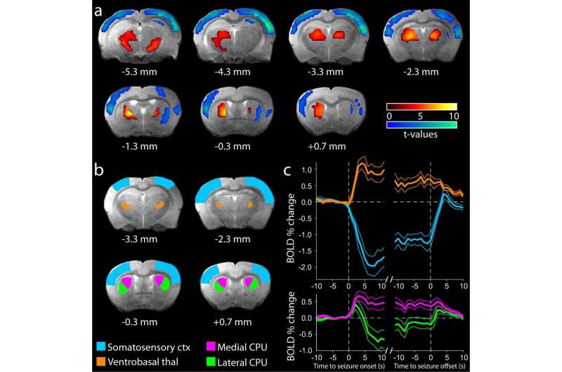 Study identifies neuronal basis of impaired consciousness in 'absence' epilepsy