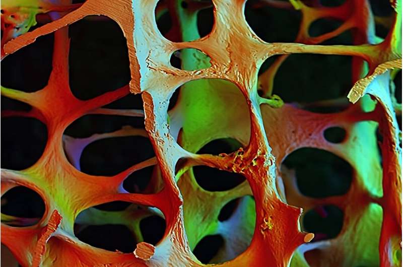 Study provides genetic evidence on new osteoporosis drug heart attack risk