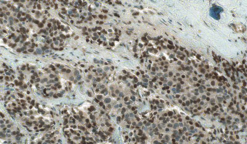 Study reveals how treatment-resistant prostate cancer provides its own hormonal fuel