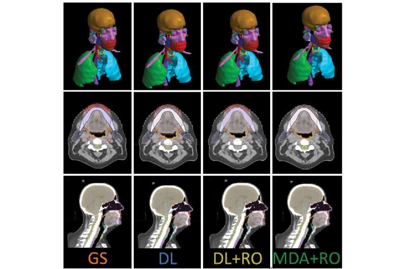 Study suggests improved time efficiency, accuracy with AI-automated head and neck radiotherapy model