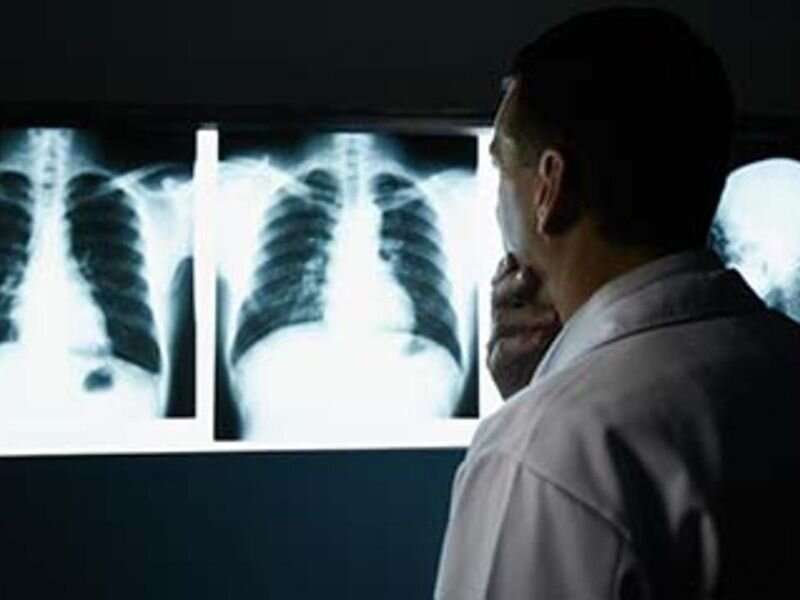 手术比目标辐射与早期肺癌患者