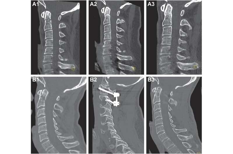 Surgical stabilization of odontoid fractures improves outcomes