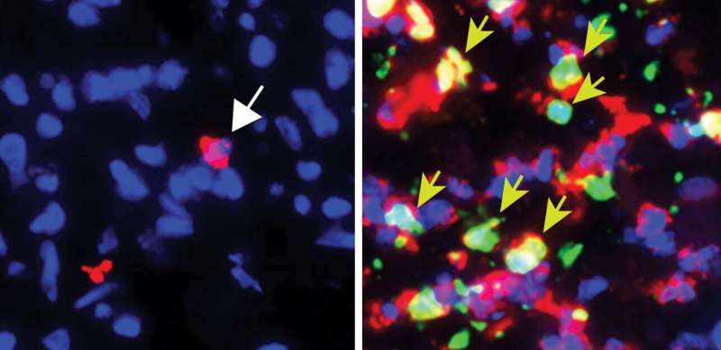 Surprise finding shows that neutrophils can be key antitumor weapons