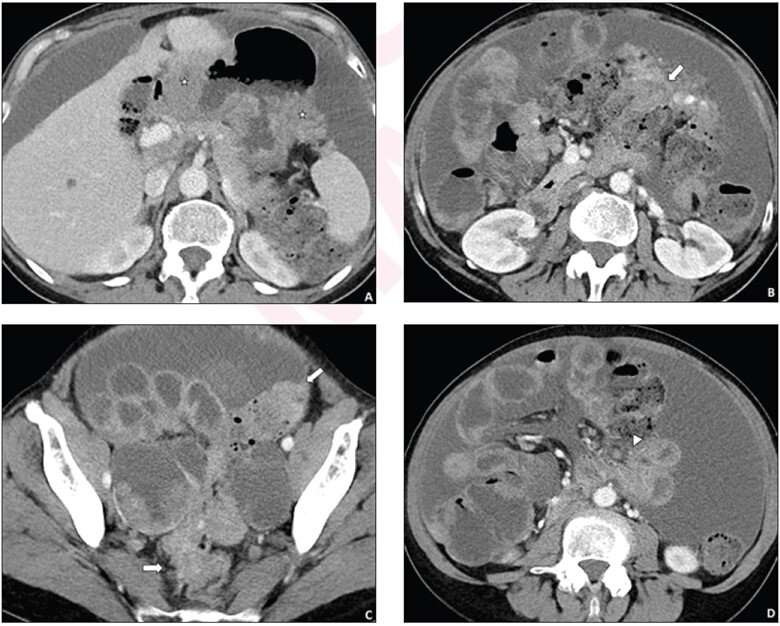 Synoptic reporting improves pretreatment CT for advanced ovarian cancer