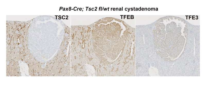 Taming Overactive mTOR in Renal Cell Cancer