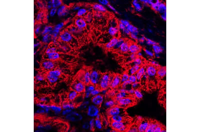 Targeting a unique metabolic pathway might starve pancreatic cancer