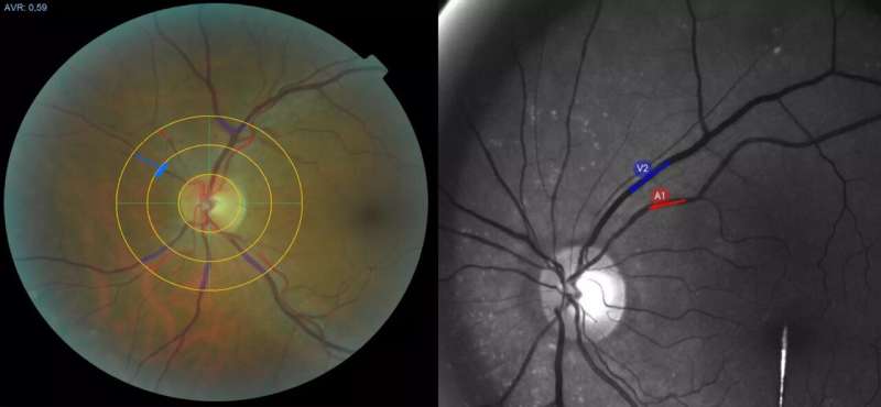 Testing for long COVID: Eye exam as a new approach