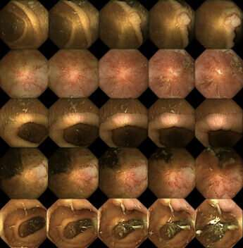 The capsule camera of the future: Images the intestines in 3D and detects disease