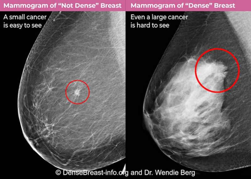 The FDA's rule change requiring providers to inform women about breast density could lead to a flurry of questions