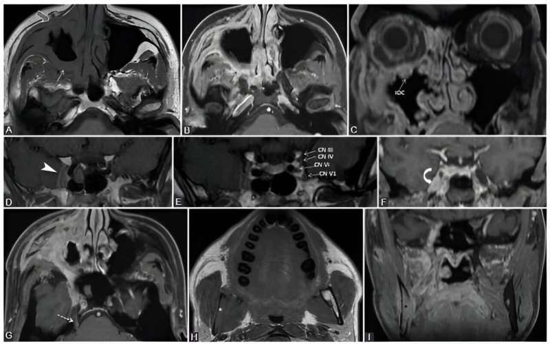 The Hidden Challenge: Imaging Perineural Invasion in Head and Neck Tumors