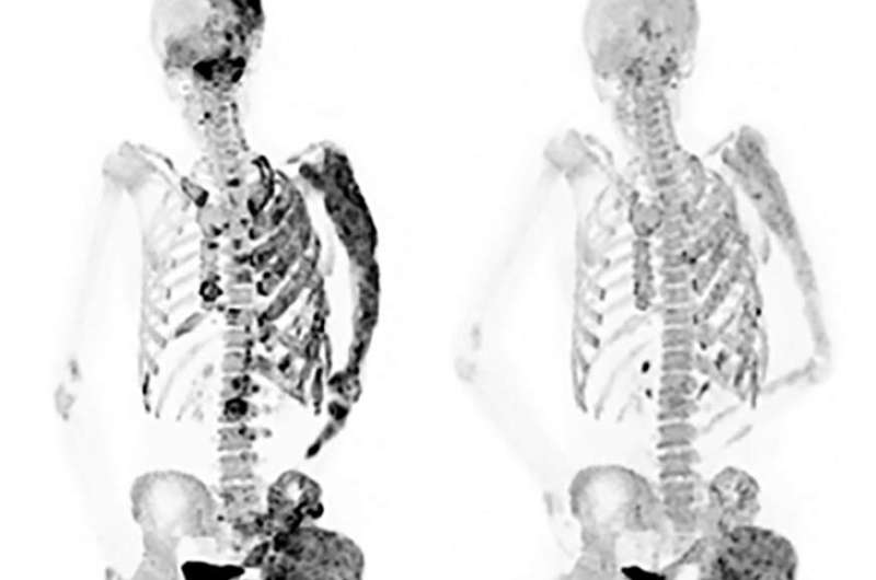 Therapy for rare bone disorder shows promise in NIH clinical trial