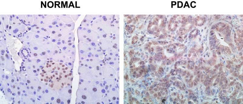 This killer protein causes pancreatic cancer