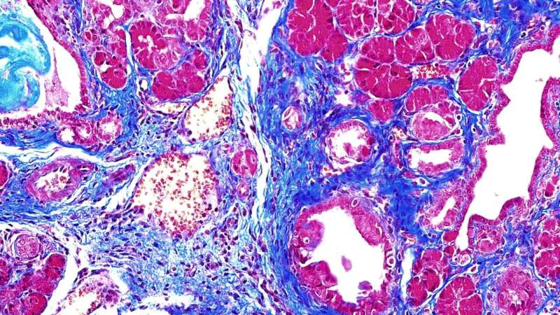 This killer protein causes pancreatic cancer