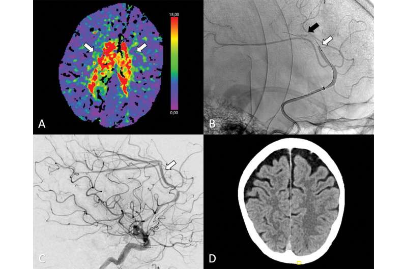 Thrombectomy comparable to medical management for strokes