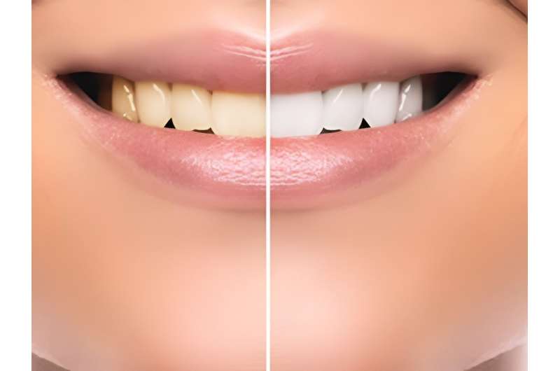 Tooth whitening: expert help on getting a brighter smile