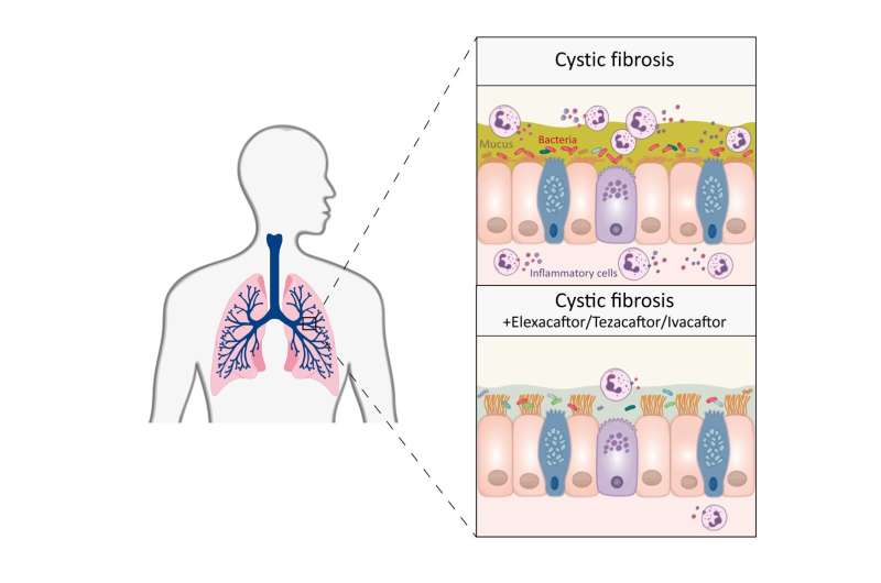 Triple combination therapy brings lasting improvement in cystic fibrosis