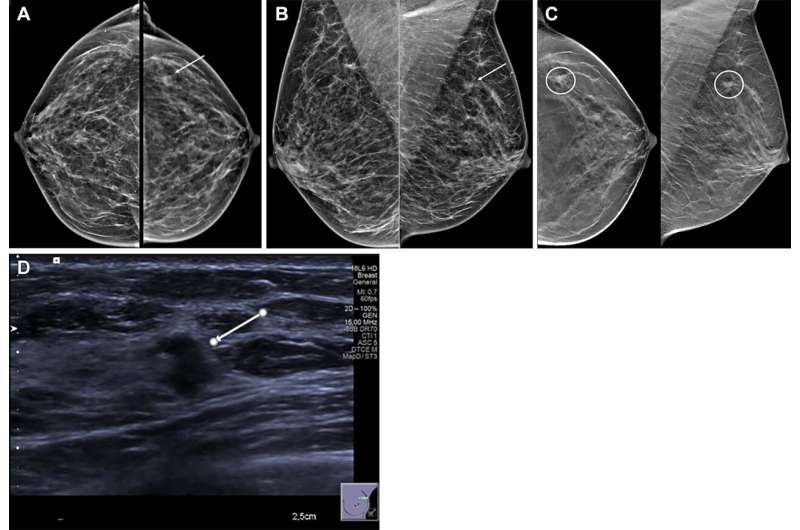 Ultrasound Effective at Diagnosing Localized Breast Lumps, Pain