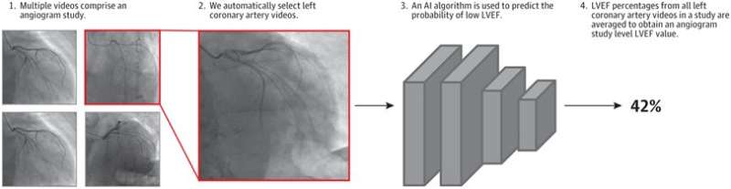 Using AI to predict important measure of heart performance