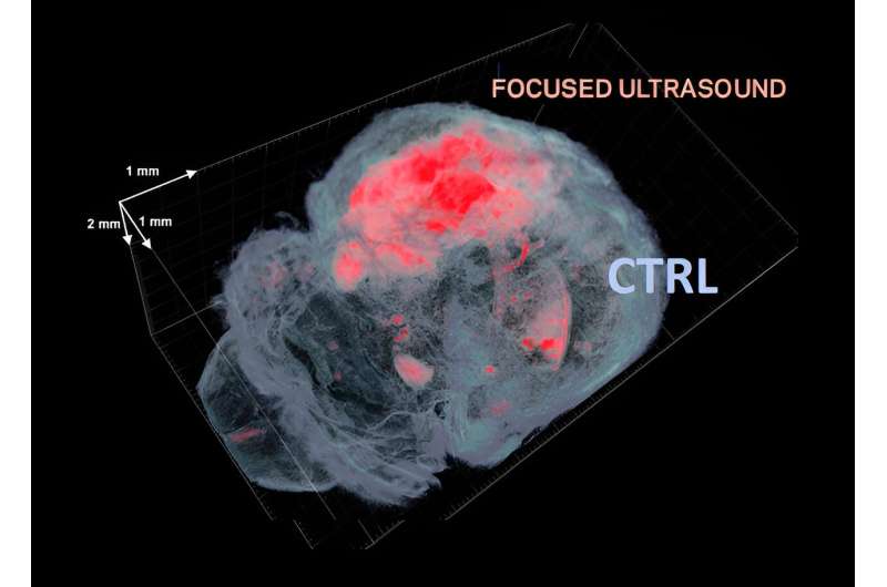 Using focused ultrasound to treat Alzheimer's and Parkinson's