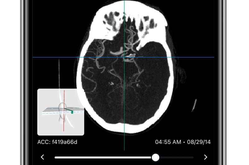 UTHealth Houston study: Artificial intelligence software improves endovascular thrombectomy treatment times for stroke patients