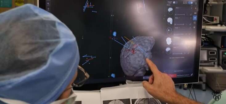 Video: A surgery option when epilepsy treatments don't work