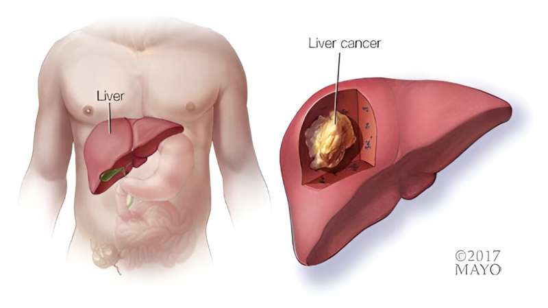 Video: Treating liver cancer