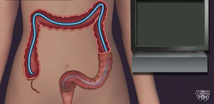 Video: Who should be screened for colorectal cancer?
