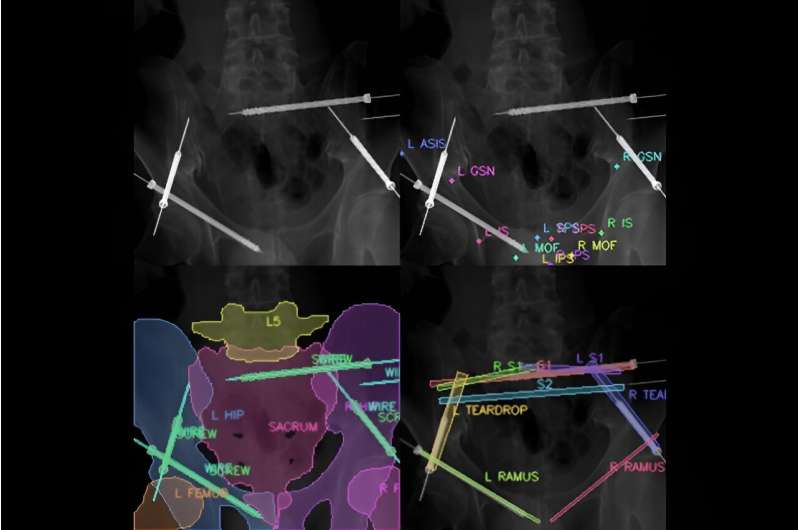 Visualization technology could improve efficiency of pelvic fracture surgery