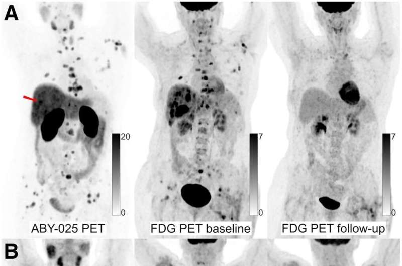 Whole-body PET/CT predicts response to HER2-targeted therapy in metastatic breast cancer patients